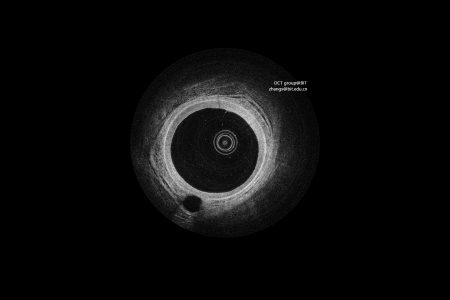 Intravascular Optical Coherence Tomography，IVOCT